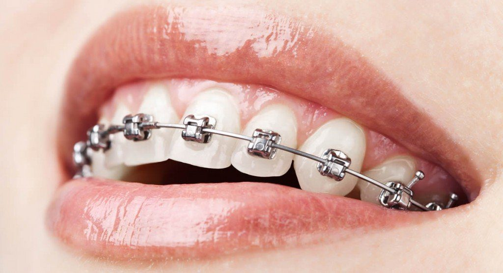 Teeth whitening and Braces 