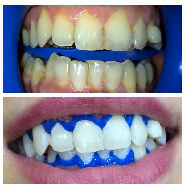Teeth Whitening gel  Before and After Pictures 